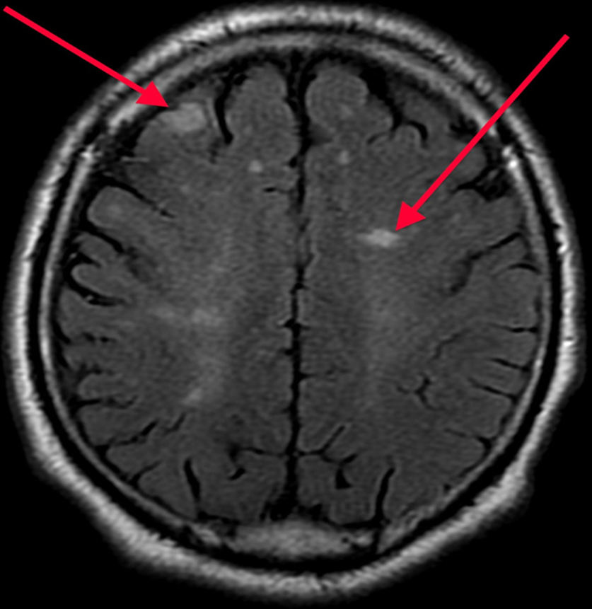 脳梗塞画像　MRI画像