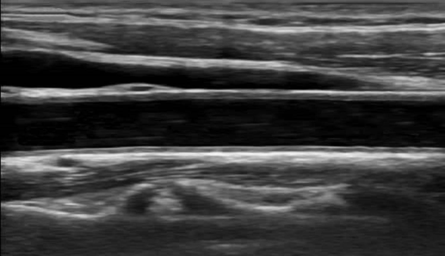 正常頸動脈　頸動脈エコー画像