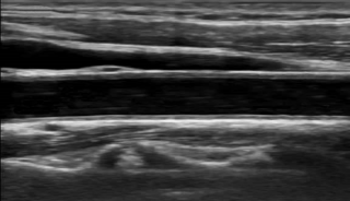 正常頸動脈　頸動脈エコー画像