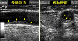 頸動脈プラーク画像　頸動脈エコー検査